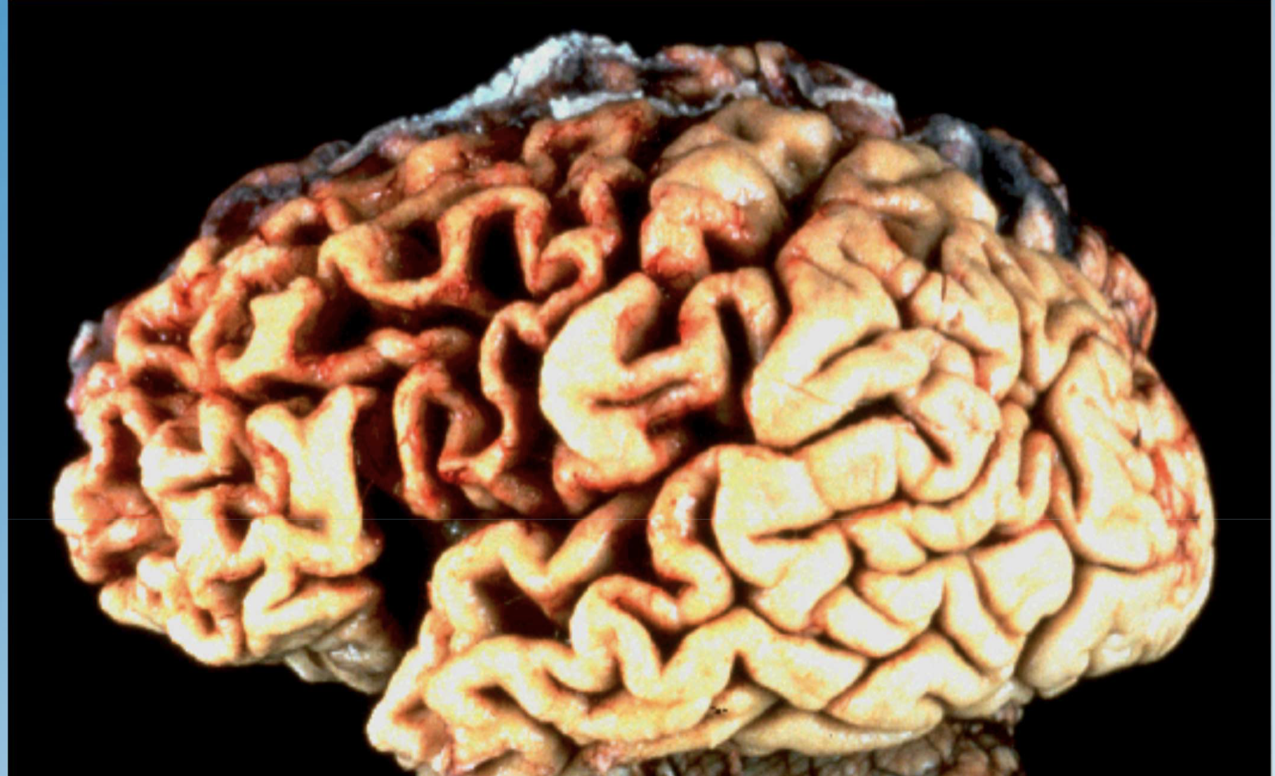 <p>Give three examples of pathologic atrophy.</p>
