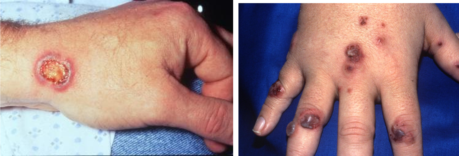 <p>rare autoimmune necrotizing vasculitis affecting small sized arteries</p><p>unknown cause</p>