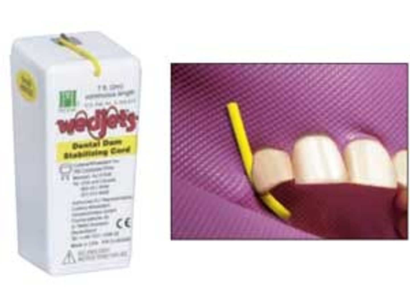 <p>Dental dam stabilizing cord, placed inter-proximal.</p>