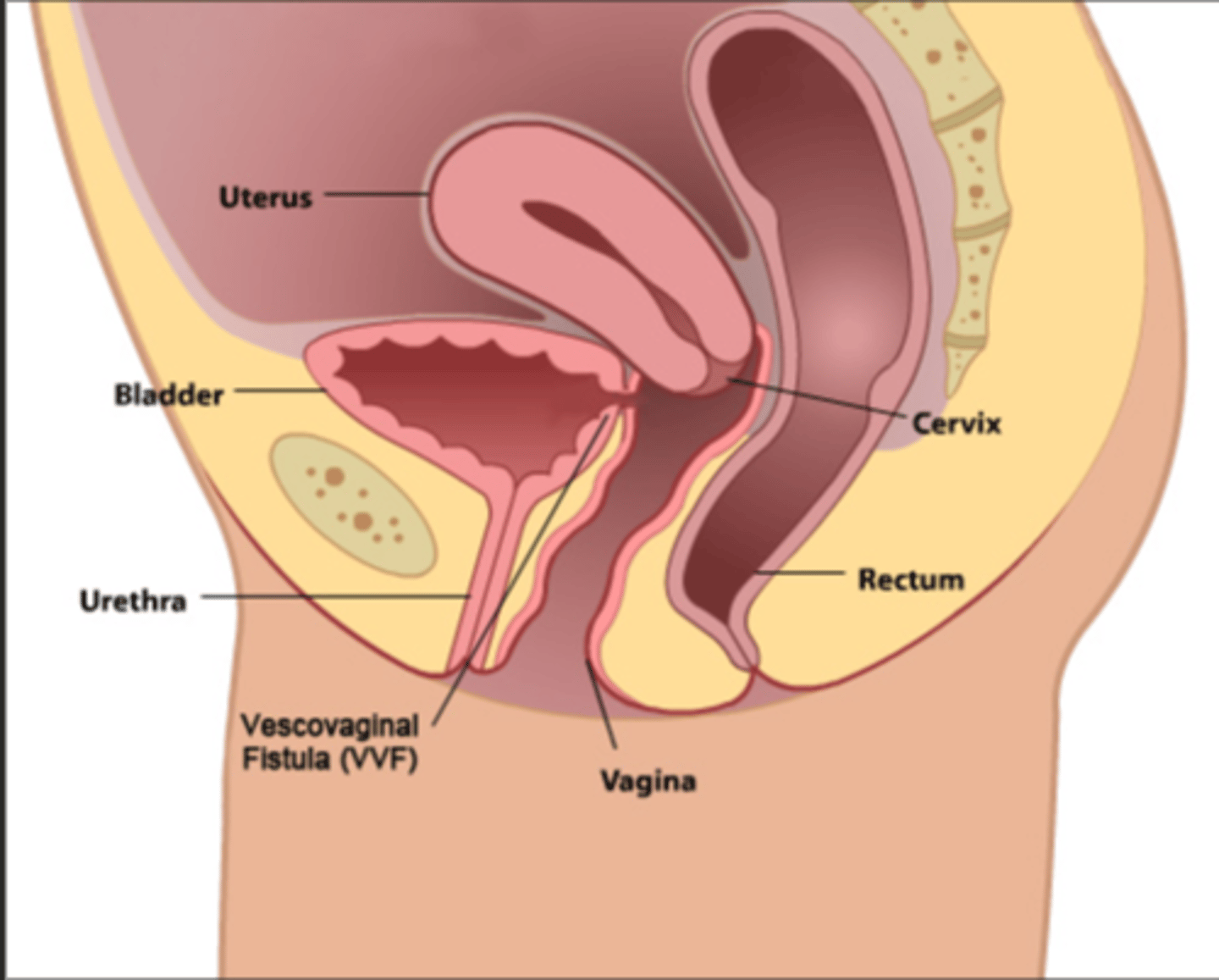 <p>a fistula between the bladder and vagina</p>