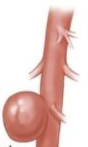 <p>What aneurysm is this</p>