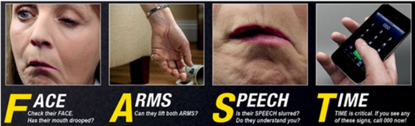 <p>A sudden attack that is caused by a lack of blood to the brain.</p>