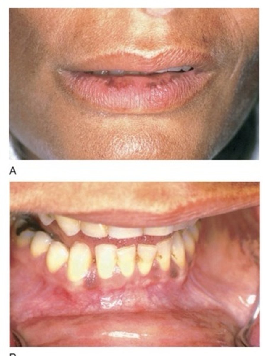 <p>This disease is caused by lack of cortisol and aldosterone. The lack of cortisol results in:</p><p>-impaired metabolism of glucose, fat, and protein</p><p>-hypotension</p><p>-increased ACTH secretion (hormone from the pituitary gland stimulates cortisol)</p><p>-impaired fluid excretion</p><p>-excessive pigmentation (bronzing of the skin)</p><p>-an inability to tolerate stress.</p><p>Aldosterone deficiency results in: inability to conserve sodium and eliminate potassium and hydrogen ions. This leads to hypovolemia (decrease in volume of blood plasma), hyperkalemia (too much potassium in blood), and acidosis (excessive acids in the body fluids).</p>