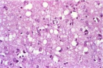 <p>Bovine spongiform encephalopathy</p>