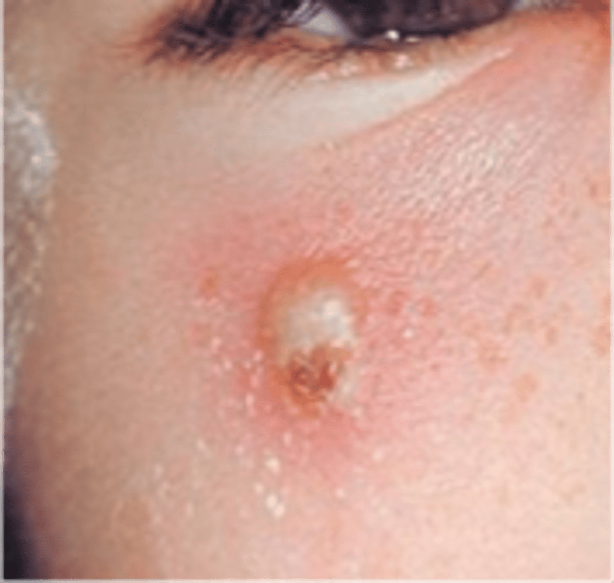 <p>Small palpable collection of pus</p><p>- Ex: Acne, impetigo</p>