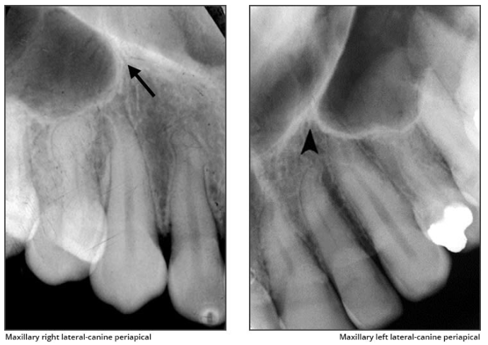 <p>Inverted Y </p><ul><li><p>intersection of the maxillary sinus and the nasal cavity </p></li><li><p>R<u>adiography: </u><strong><u>radiopaque</u></strong><u> upside-down Y located above the maxillary canine</u></p><ul><li><p><em>formed by the intersection of the lateral wall of the nasal fossa and anterior  border of the maxillary sinus</em></p></li></ul></li></ul><p></p>
