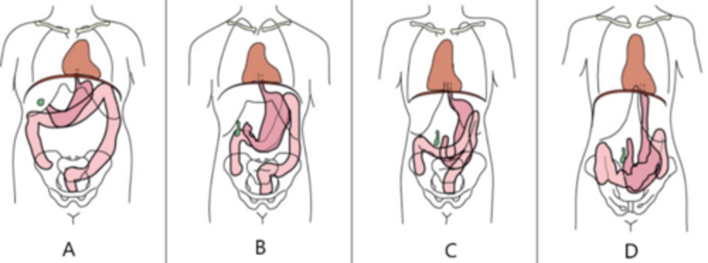 <p>Which of these illustrations represents the sthenic body habitus?</p>