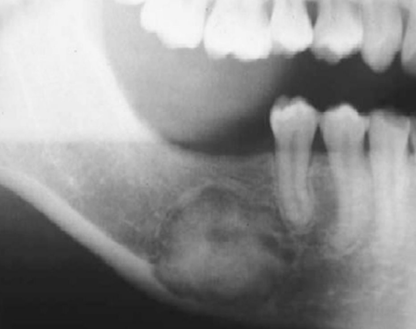 <p>benign bone neoplasm</p><p>3-4th decade</p><p>mandible &gt; maxilla</p><p>asymptomatic</p>