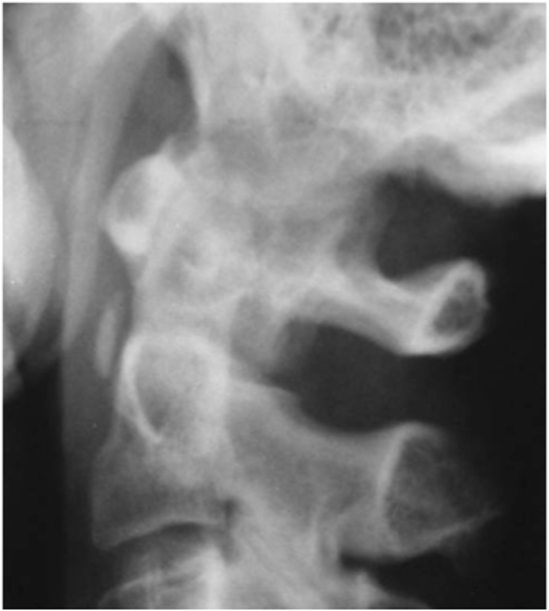 <p>Hydroxyapatite deposition disease (HADD) of the _____</p>