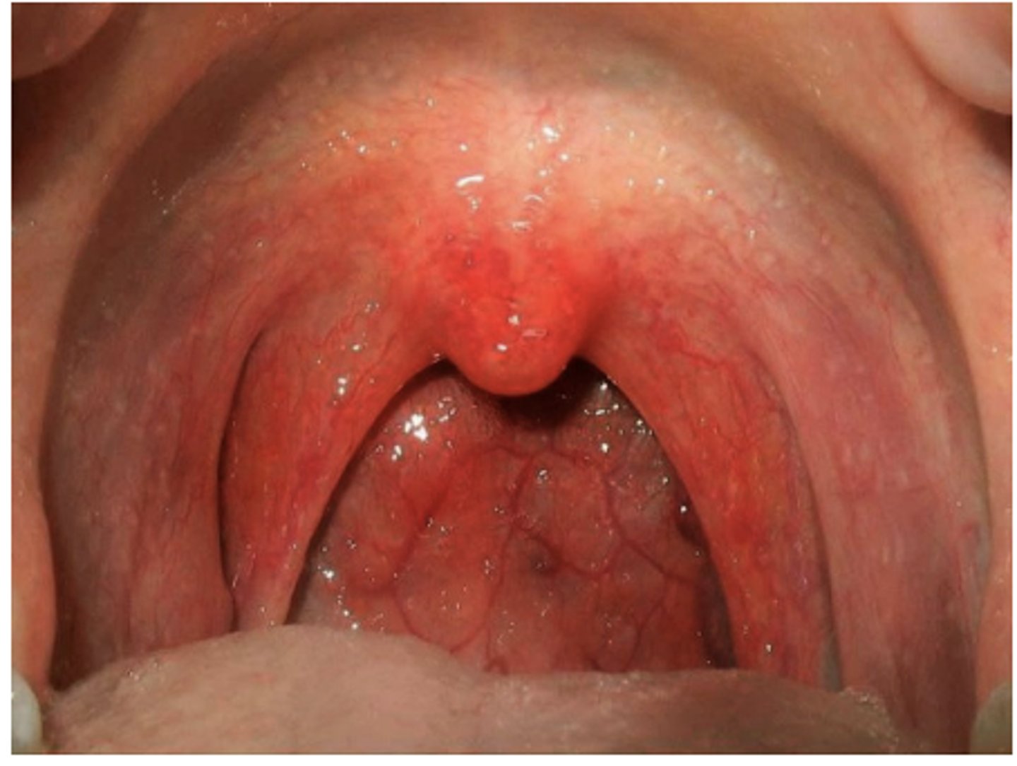 <p>Type of Adenovirus</p><p>- 1-7</p><p>Symptoms</p><p>- Redness</p><p>- Blistering</p><p>Duration:</p><p>-3-5 days or longer</p>