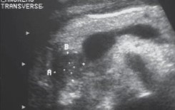 <p>The patient presented with some jaundice and an US was ordered. What can be assumed here?</p>