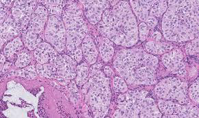 <p>Jugular para-ganglioma of middle ear</p><p>M/P:</p><p>1.Classic nests called “zellballen”; the central cells are rounded with abundant eosinophilic granular cytoplasm.</p><p>2.Sustentacular cells are flat cells &amp; present at the periphery of the nests.</p><p>3.Prominent fibrovascular stroma separates the nests.</p>
