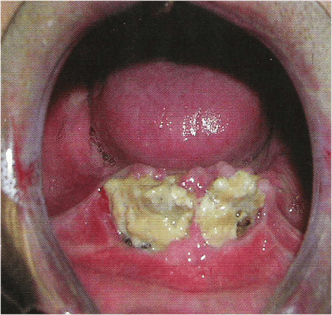 <p>death of bone tissue associated with bisphosphonate therapy</p>