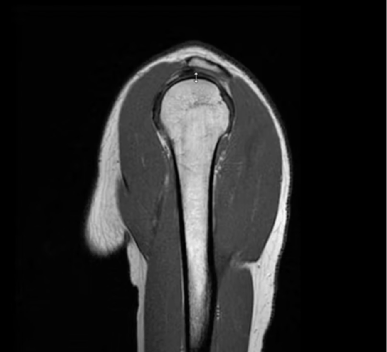 <p>If there was a supraspinatus tear, where would you see it? Why?</p>