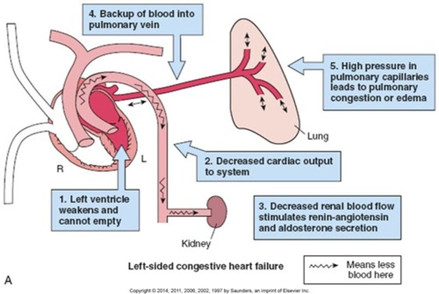 <p>A. CORRECT. Chronic hypertension can lead to weakness in the left ventricle of the heart. This weakness in the heart can progress to CHF when the ventricle fails.</p><p>B. Atherosclerosis is caused by the formation of plaque in the arteries leading to the heart. Although this condition can lead to a myocardial infarction, it si not a cause of CHF.</p><p>C. Endocarditis can cause scarring of the cardiac tissue, which can lead to mitral</p><p>valve prolapse. It does not cause CHF.</p><p>D. CHF is a secondary diagnosis that develops as a result of other preexisting conditions. Although these other pre-existing conditions can be hereditary, CHF itself is not a hereditary condition.</p>