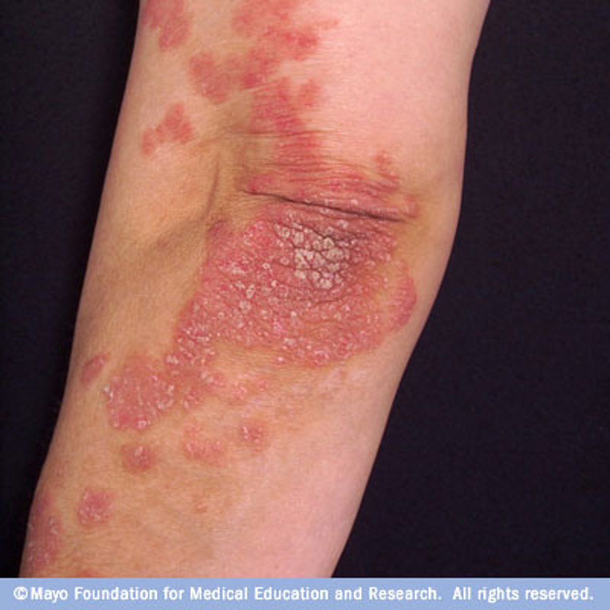 <p>elevated lesion</p><p>larger than 1 cm</p><p>ex: psoriasis</p>