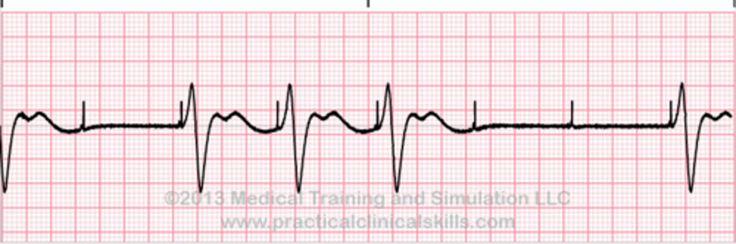 <p>Spikes with no QRS</p>