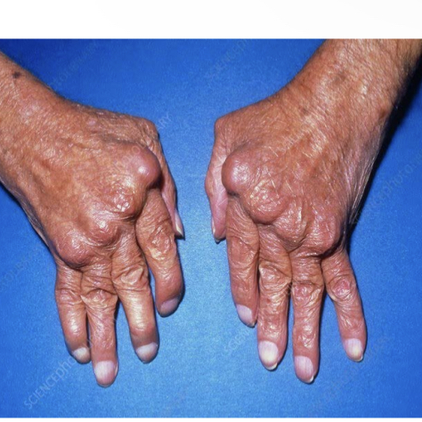 <p>What is rheumatoid arthritis</p>