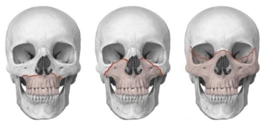 <p>What would a fracture in this area be called?</p>