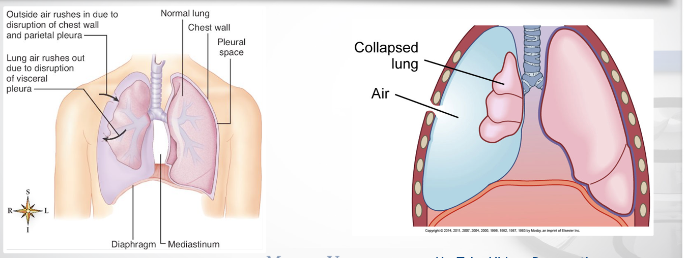 <p>open: Air enters through an opening in the chest wall</p><ul><li><p>penetrating trauma</p></li></ul><p>Closed: No external wound</p><ul><li><p>visceral lining is interrupted </p></li></ul><p></p>