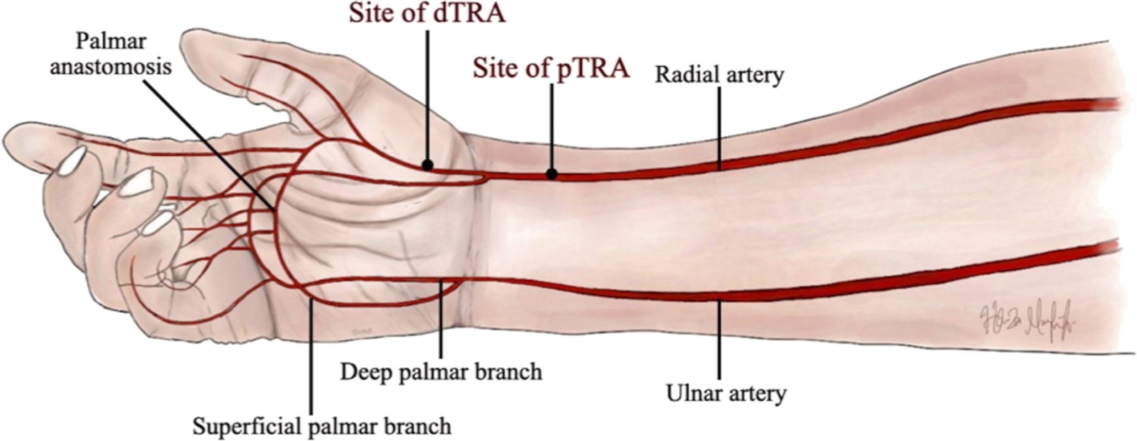 <p><span>Patient and operator comfort since the hand can be neutral or pronated and operator and equipment positioning may be similar to femoral access; access is distal to the superficial palmar branch of the radial artery supplying the superficial palmar arch, theoretically reducing risk of hand ischemia with distal radial artery occlusion.</span></p>