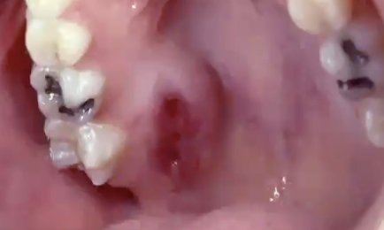 <p>What is the treatment for mucoepidermoid carcinoma?</p>