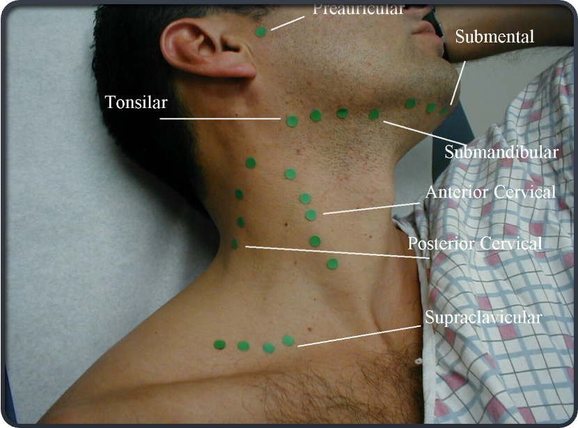 <p>most common neck mass at any age</p>