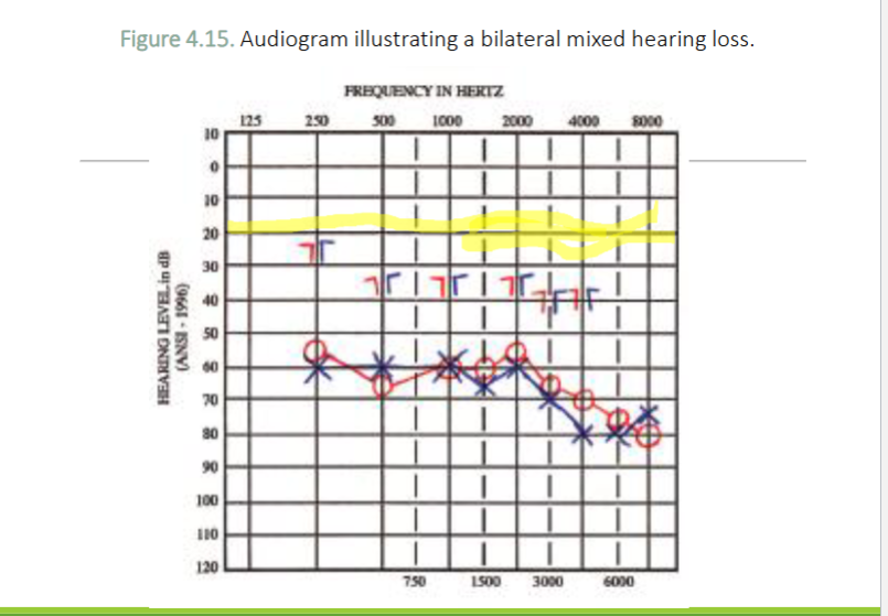 <p>What type of hearing loss is this</p>