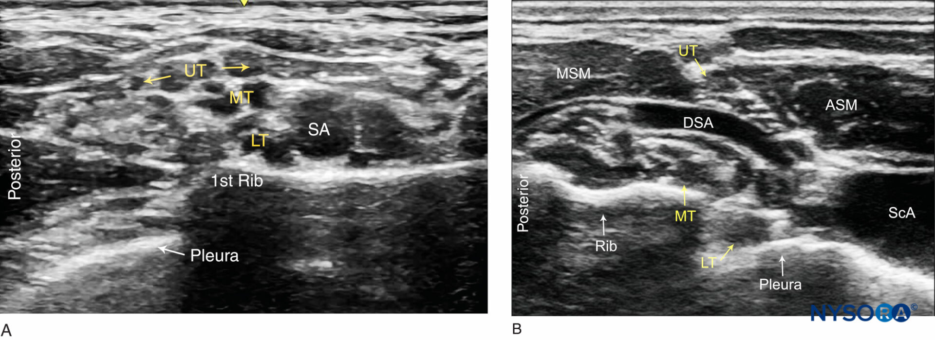 <p>Dorsal scapular artery</p><p></p>