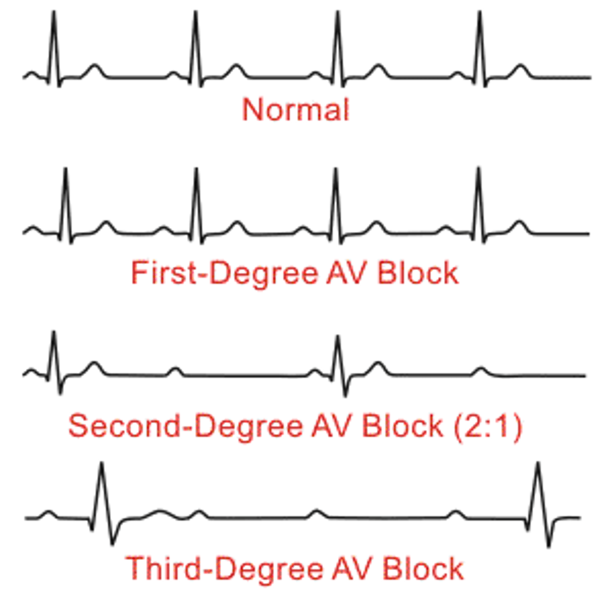 <p>if the ps and qs don't agree then you have 3rd degree most deadly blocked at AV nodes assessment: even or extra slow heart rate <40BPM, galloping heart rate, hypoxia, Syncope (fainting)*theses causes and Treatments are the saem for 2nd degree*causes: meds: CCB, Beta-blockers, Digoxin, HX of MItreatment: reset the heart by stopping the meds if that doesnt work then we'll give Atropine (increase heart rate) Dopamine (increase BP), and epinephrine (to do both) to increase CO, if that doesn't work PACEMAKER</p>