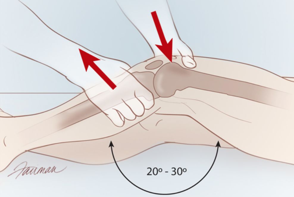 <ol><li><p>Patienten ligger på rygg med knäet lätt böjt (ca 20-30°) </p></li><li><p>(Du kan ha ditt knä under patientens lår för att “hålla uppe benet”) </p></li><li><p>Placera en hand på låret för att stabilisera femur och den andra på underbenet, precis under knäet.<strong> Håll lednära</strong></p></li><li><p>Dra tibia snett framåt och uppåt (dra längs med ledspringan) i en snabb kontrollerad rörelse </p></li><li><p>Notera ökad anterior glidning och end-feel</p></li></ol><p><strong> Vid ökad förskjutning ventralt misstänks ruptur av främre korsbandet</strong></p>