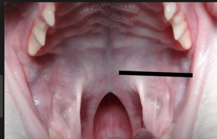 <p>posterior portion, not supported by bone</p>