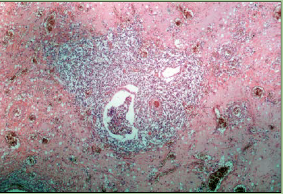 What disorder is this?