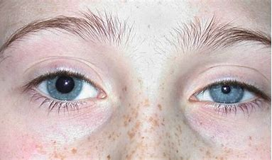 <p>= pupils of 2 different sizes (normal in a small % of the population)</p>