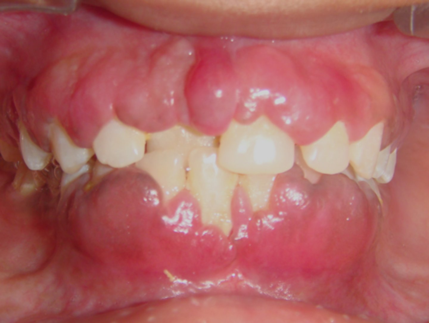 <p>drug-related gingival hyperplasia</p>