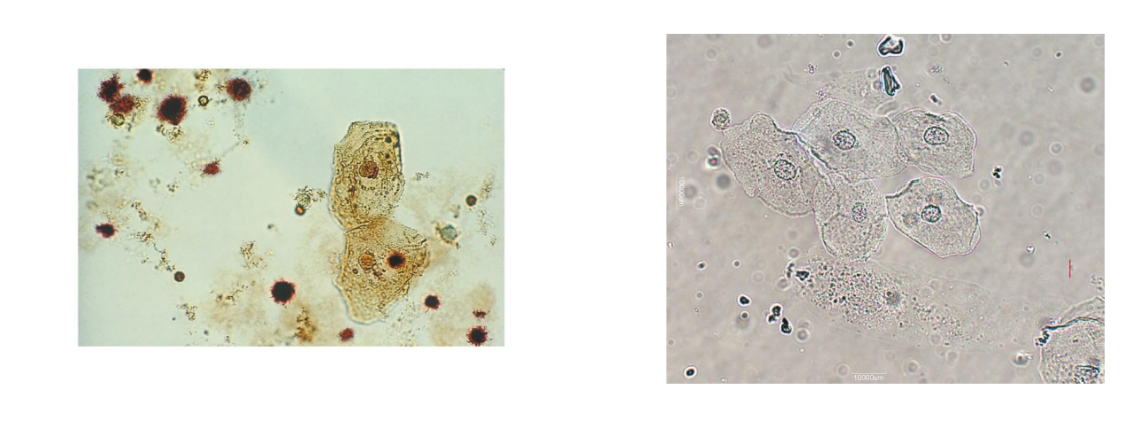 <p><span>Largest cell in urine</span></p><p><span>Good for focusing microscope</span></p><p><span>Rare, few, moderate, many</span></p><p><span>lpf or hpf per laboratory</span></p><p><span>Normal sloughing</span></p><p><span>Contamination if not midstream clean-catch</span></p>