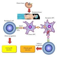 <p><mark data-color="purple" style="background-color: purple; color: inherit;">Adaptive immune response</mark></p><ul><li><p><strong>Alloreactive T/B cells</strong> recognise alloantigens on graft</p></li><li><p><strong>Alloreactive T cells</strong> drive the immune response which may lead to rejection</p></li></ul><p></p>