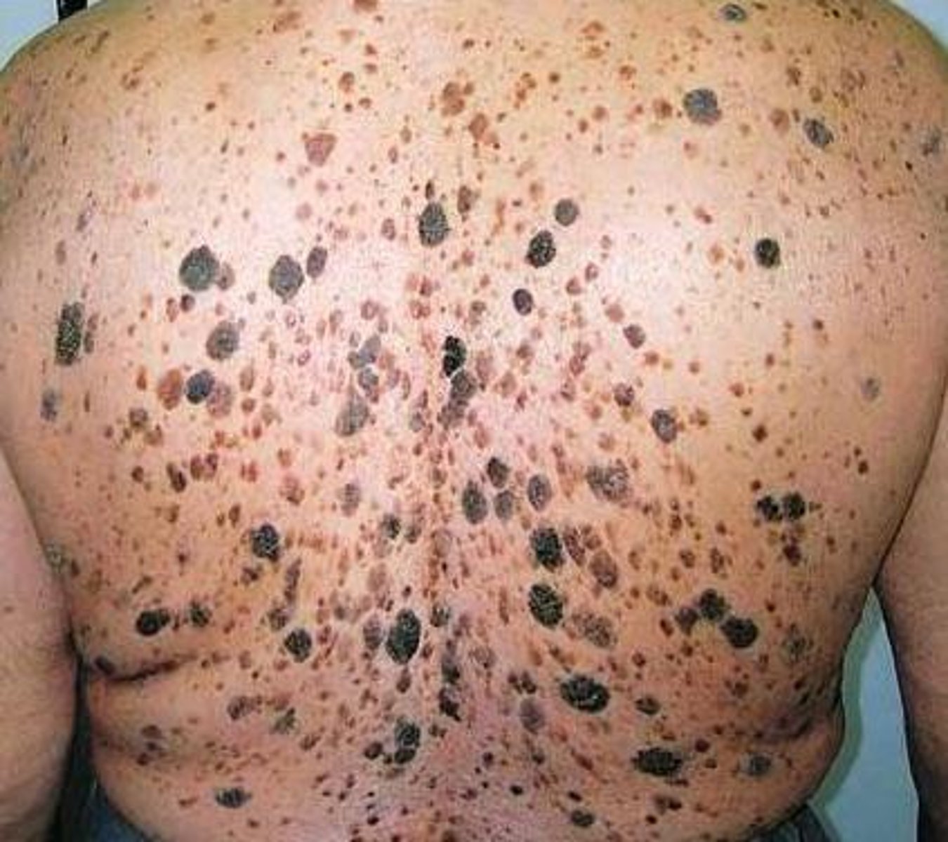 HSN pictures Flashcards Knowt