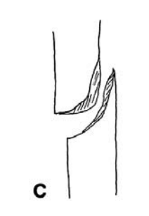 <p>indirect fractures Rotational </p>