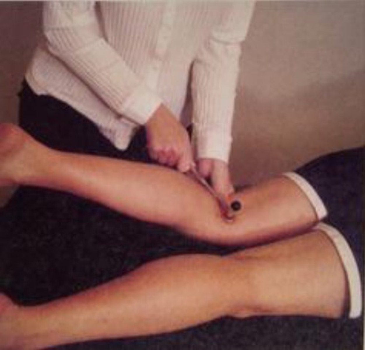 <p>medial hamstring tendon</p>