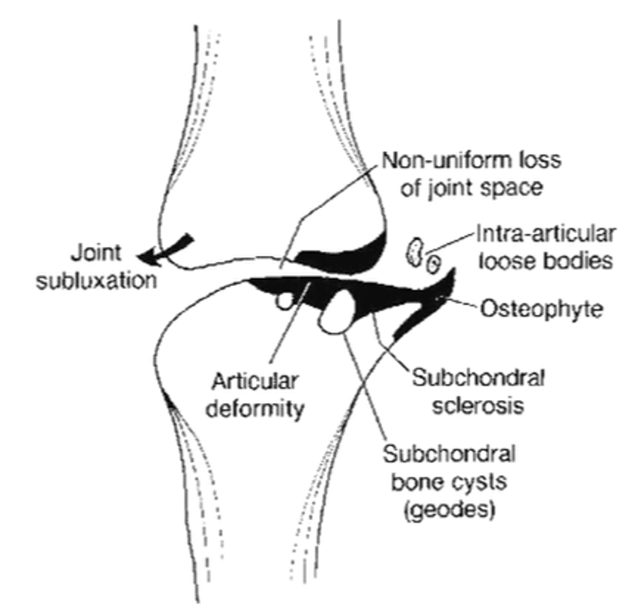<p>State the radiographic findings of osteoarthrosis</p>