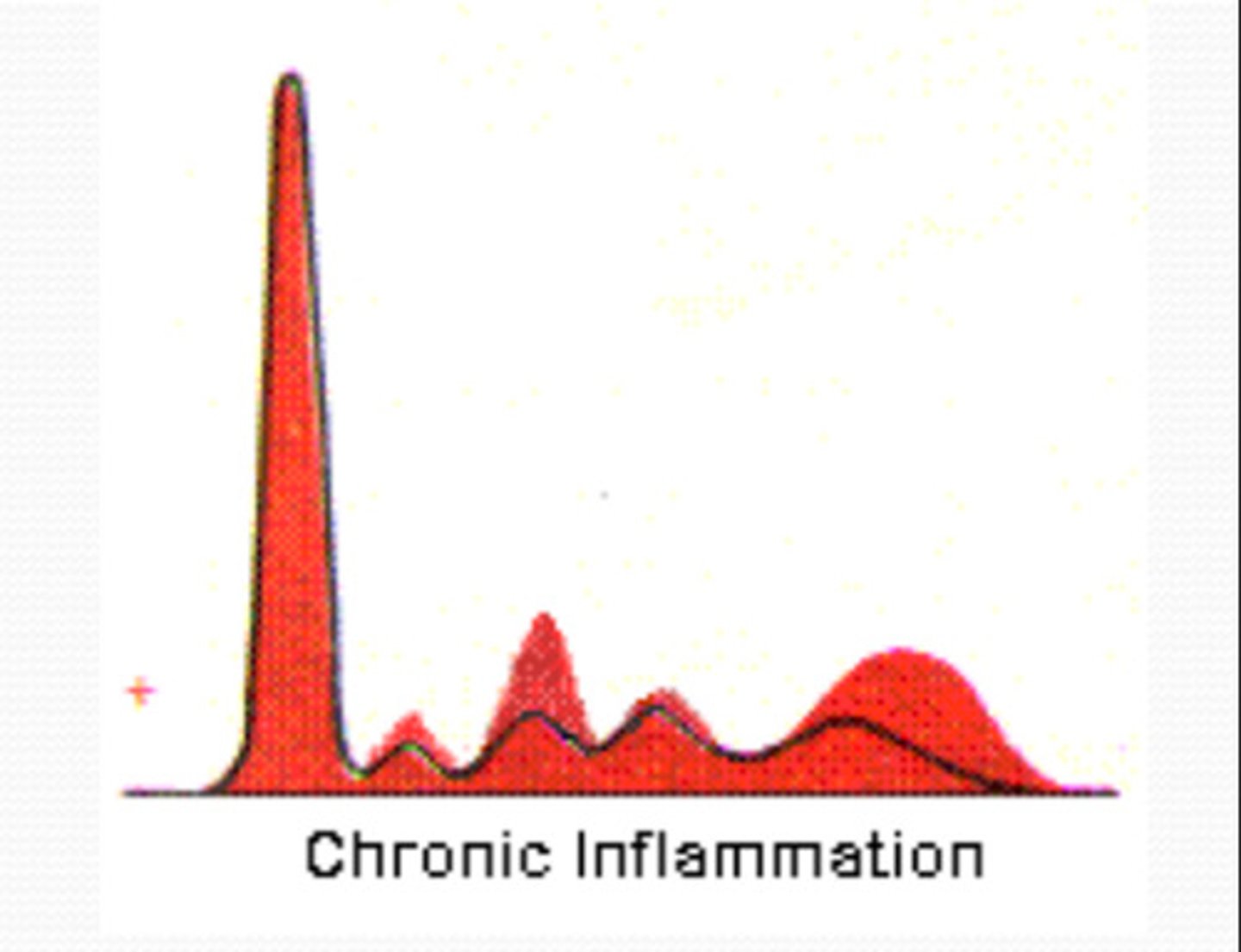 <p>Long-lasting, out-of-control inflammatory response that continues for more than a few weeks</p>