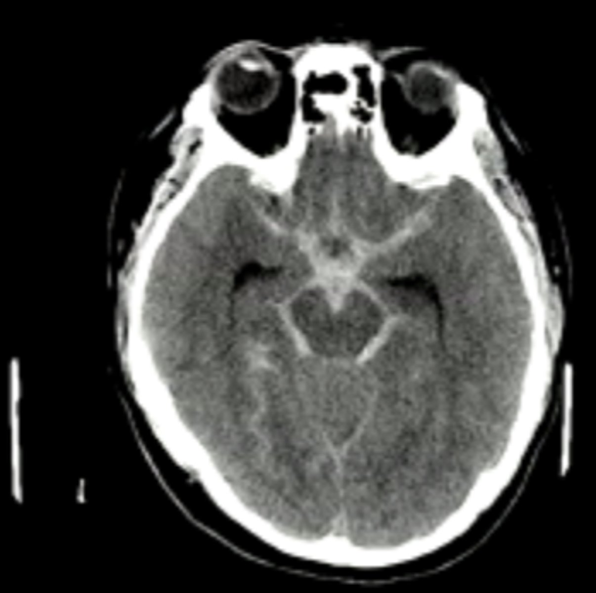 <p>White blood in cisterns and 4th ventricle</p>