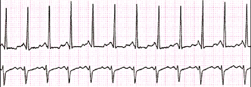 <p>Rate: 100-160 BPM<br>Rhythm: Regular<br>P-Wave: Present and Consistent<br>PR: 0.12-0.20<br>QRS: 0.06-0.10</p>
