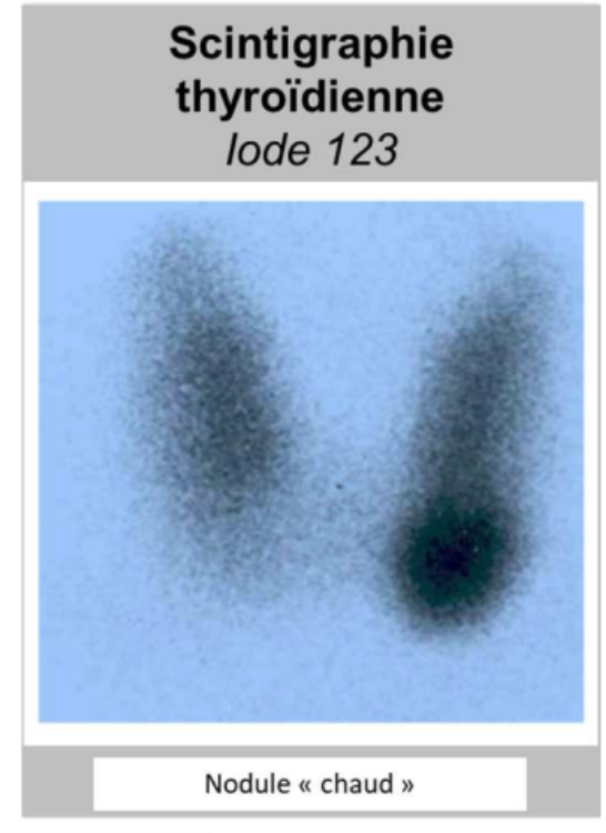 <ul><li><p>On peut faire <strong>des scintigraphies thyroïdiennes </strong>avec de l’iode 123. On peut voir ici un nodule chaud, quelque chose qui va surproduire des hormones thyroïdiennes. Ce nodule chaud peut évoluer en adénome ou en adénocarcinome</p></li></ul><p></p>
