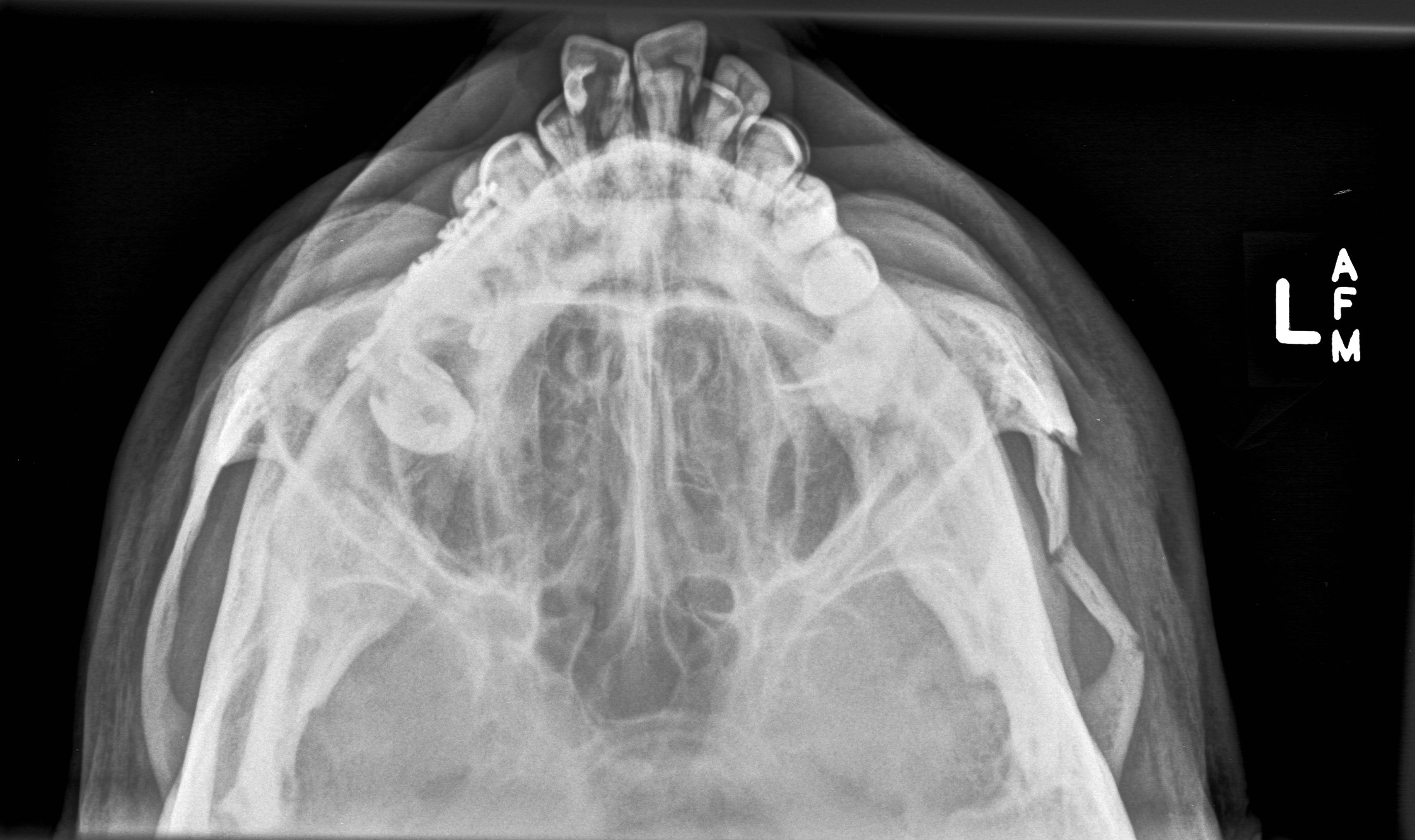 <p><strong>What pathology do you see in this image?</strong><br>A. Depressed fracture of left zygomatic arch<br>B. There is no pathology<br>C. Sinusitis</p>