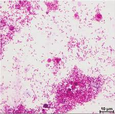 <p></p><p><strong>Tiny pink rods (Gram-negative coccobacilli, hard to see with Gram stain).</strong></p><p>Type: Bacteria (lives inside cells); Disease: <strong>Rocky Mountain Spotted Fever (RMSF);</strong> Diagnosis: Fever, rash (starts on wrists/ankles), blood tests (PCR, serology); Treatment/Prevention: Doxycycline; tick avoidance; Spread/Unique: Spread by ticks; damages blood vessels → rash + organ damage.</p>
