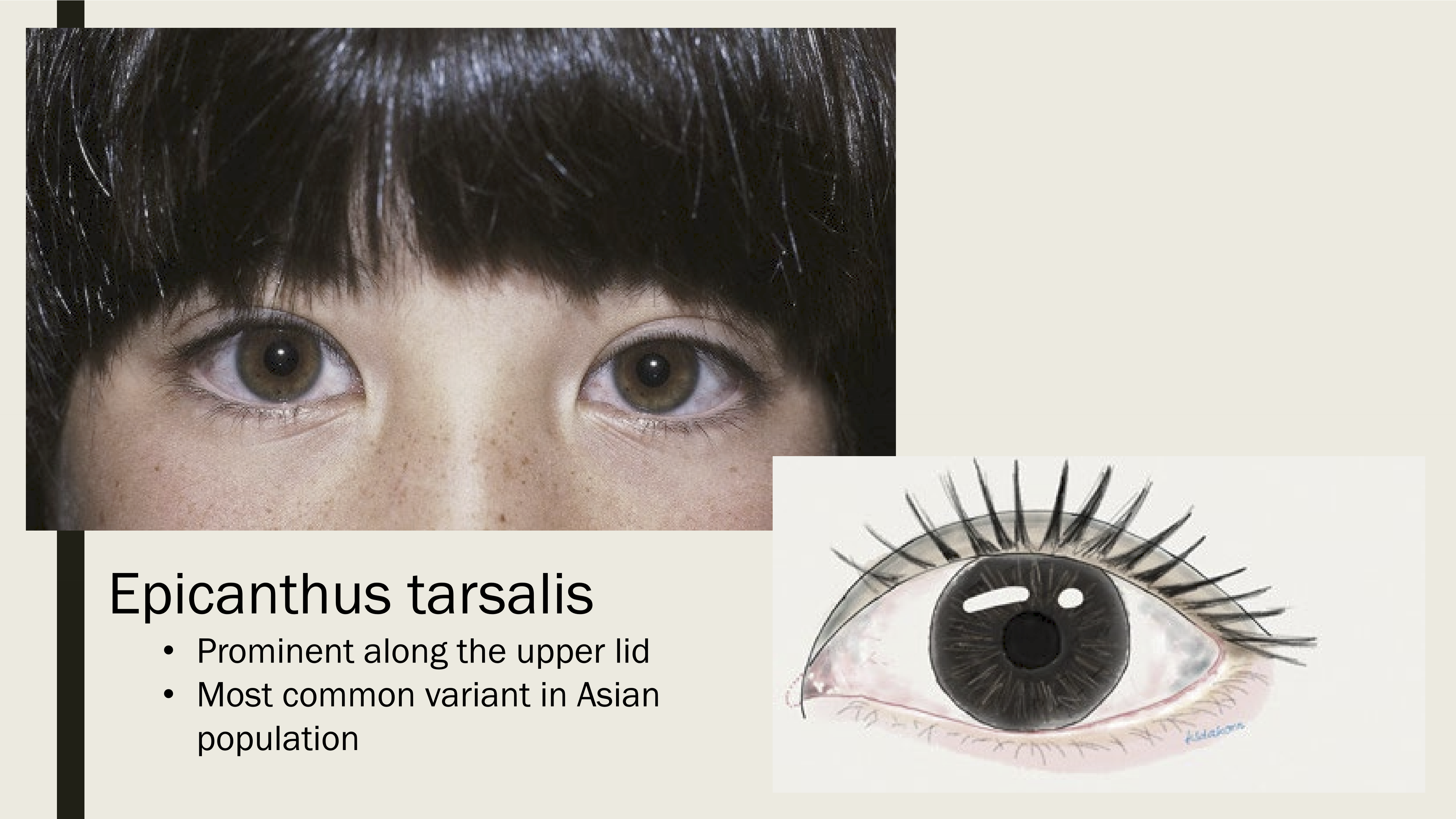 <p>Prominent skin along the upper lid, most common variant in asian population </p>