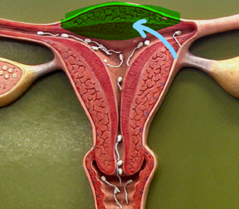 <p>Fundus of Uterus</p>