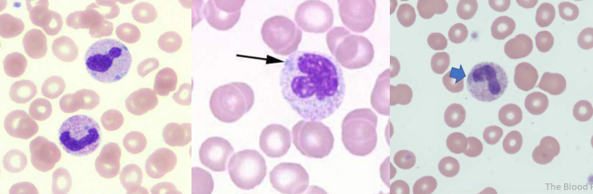 <p>A. Identify the abnormality / cell</p><p>B. This is seen in what condition / disease</p>